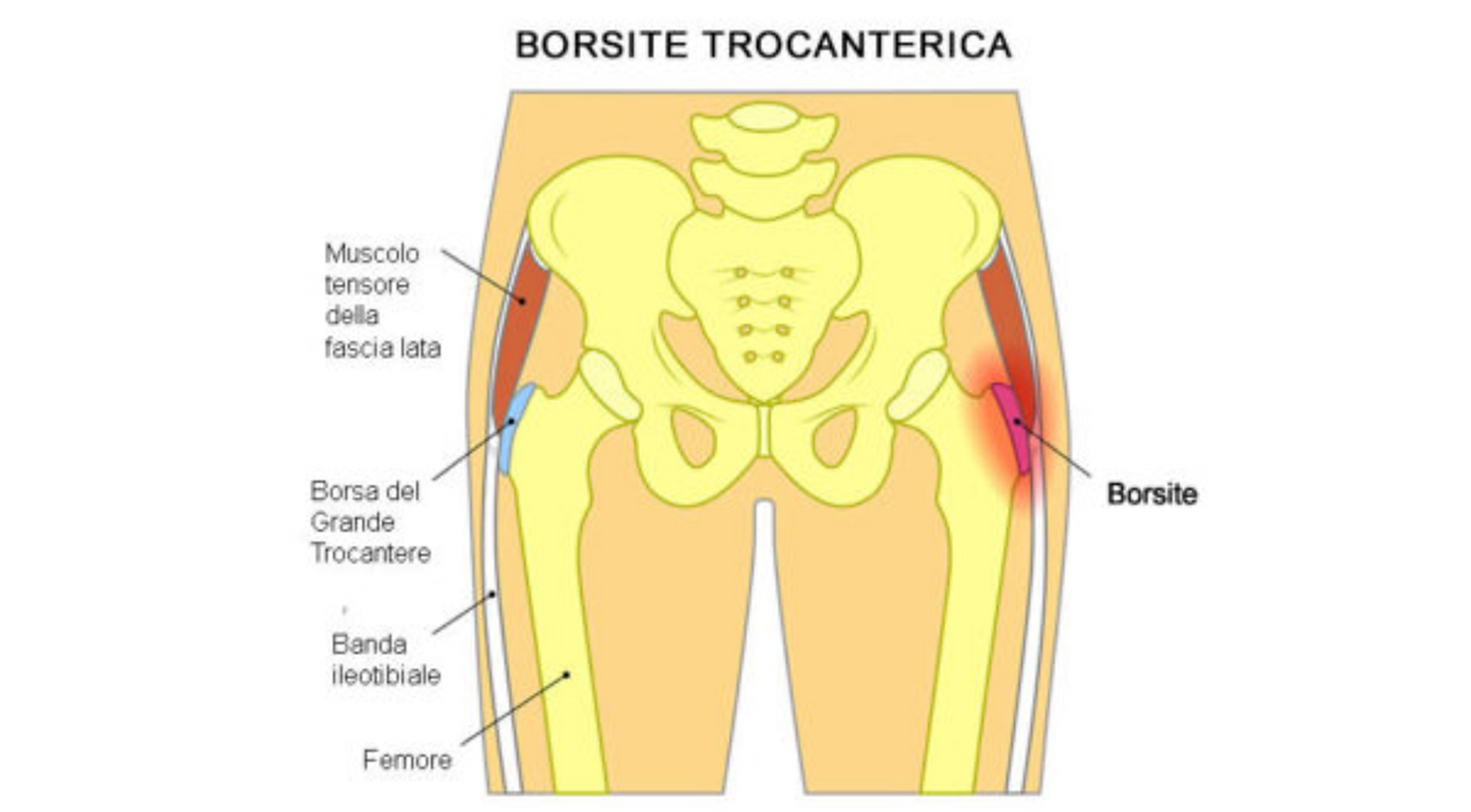 Cause borsite trocanterica