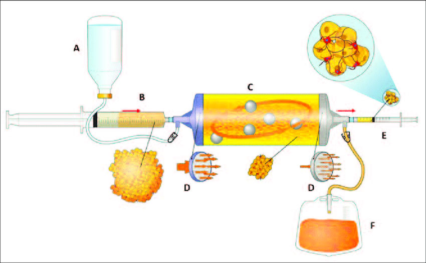 Lipogems Roma