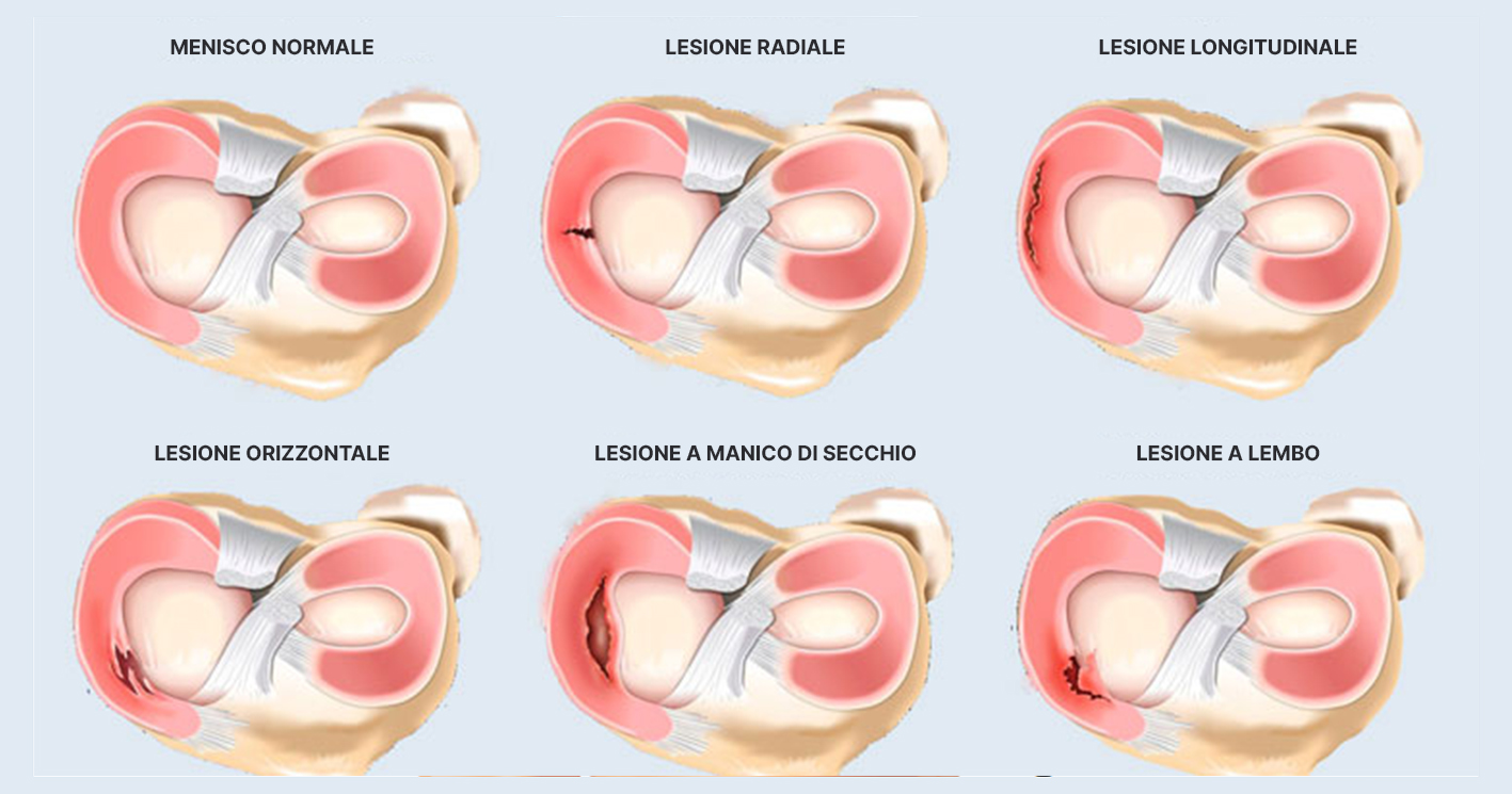 Tipologie di lesioni al menisco