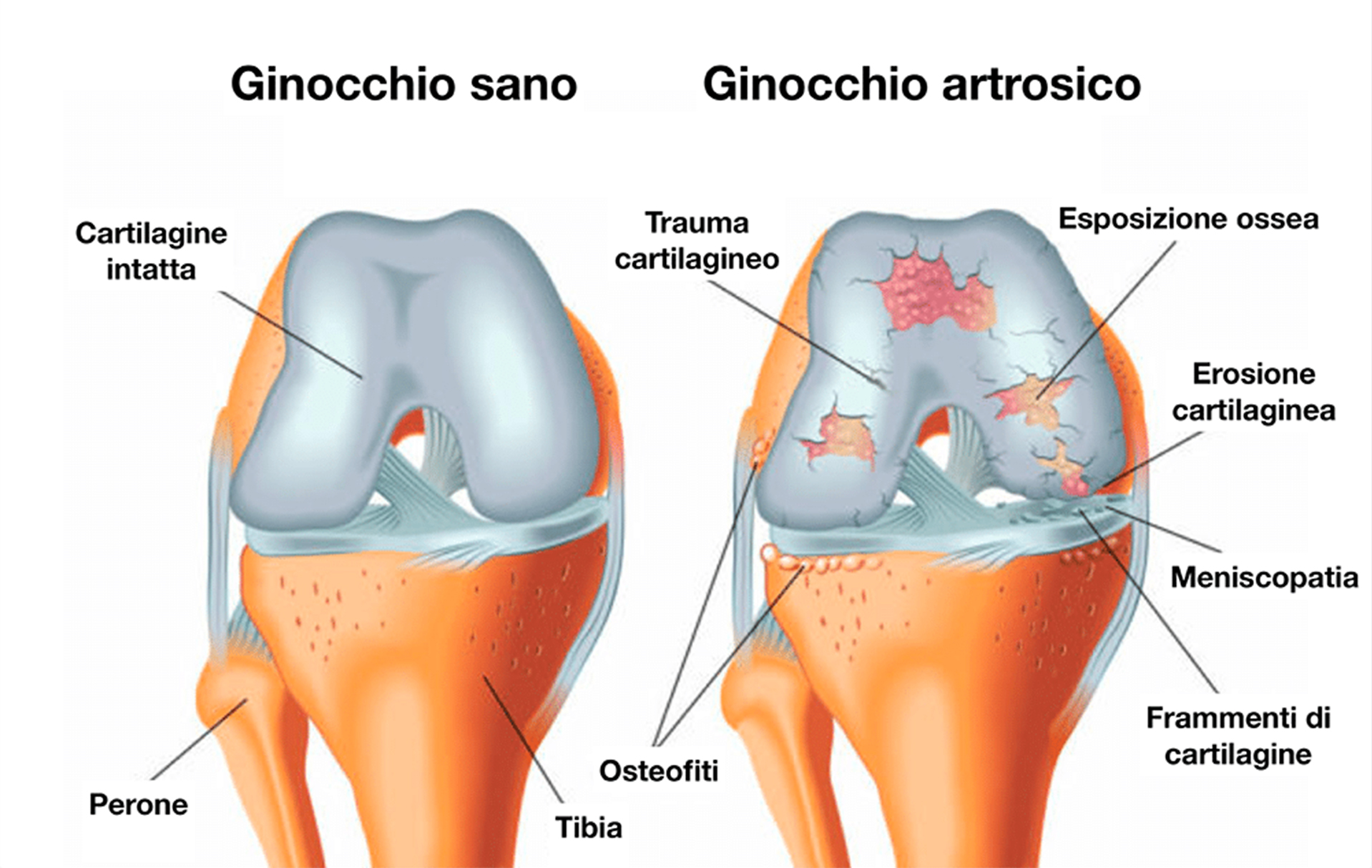 Artrosi di ginocchio