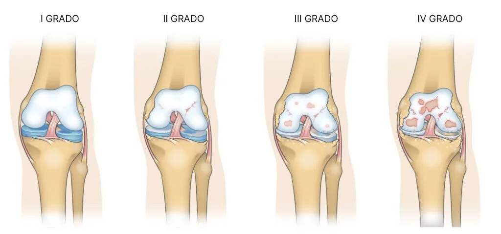 Gradi della condropatia femoro rotulea