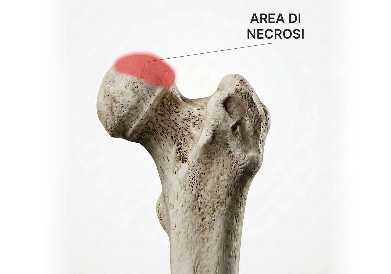 Area di necrosi del femore
