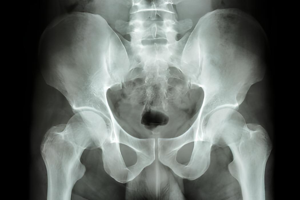 Esami diagnostici rattura branca ileo pubica e ischio pubica.jpeg